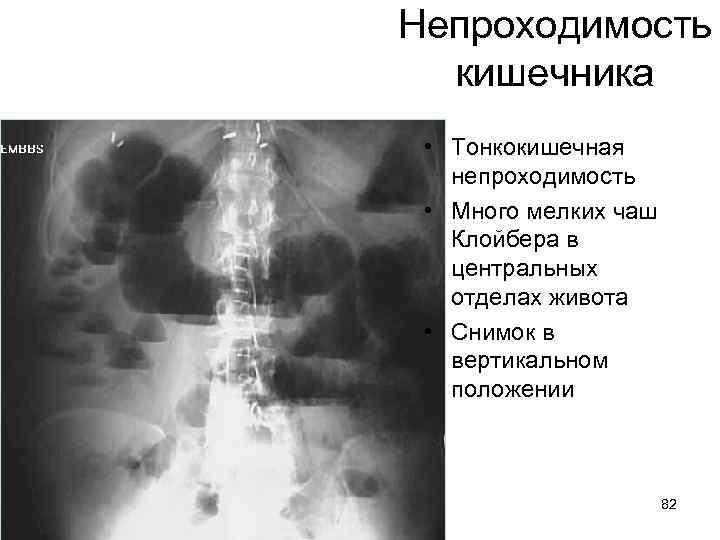 Непроходимость кишечника • Тонкокишечная непроходимость • Много мелких чаш Клойбера в центральных отделах живота