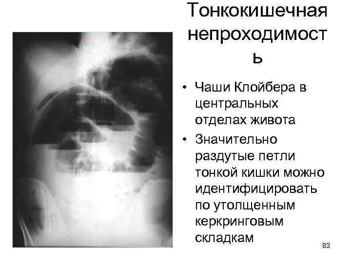 Тонкокишечная непроходимост ь • Чаши Клойбера в центральных отделах живота • Значительно раздутые петли