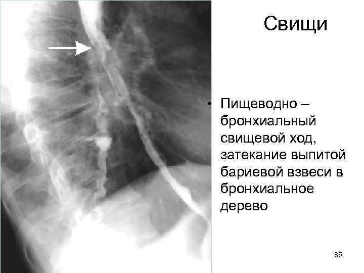 Свищи • Пищеводно – бронхиальный свищевой ход, затекание выпитой бариевой взвеси в бронхиальное дерево