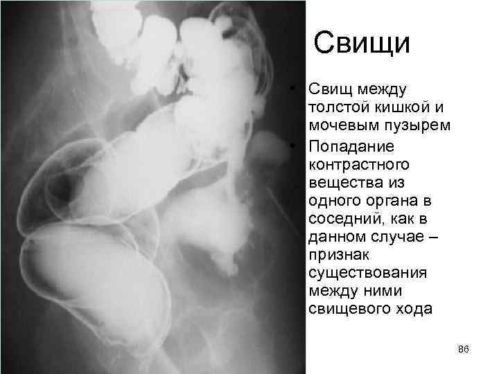 Свищи • Свищ между толстой кишкой и мочевым пузырем • Попадание контрастного вещества из