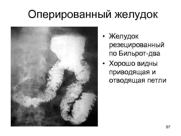 Оперированный желудок • Желудок резецированный по Бильрот-два • Хорошо видны приводящая и отводящая петли