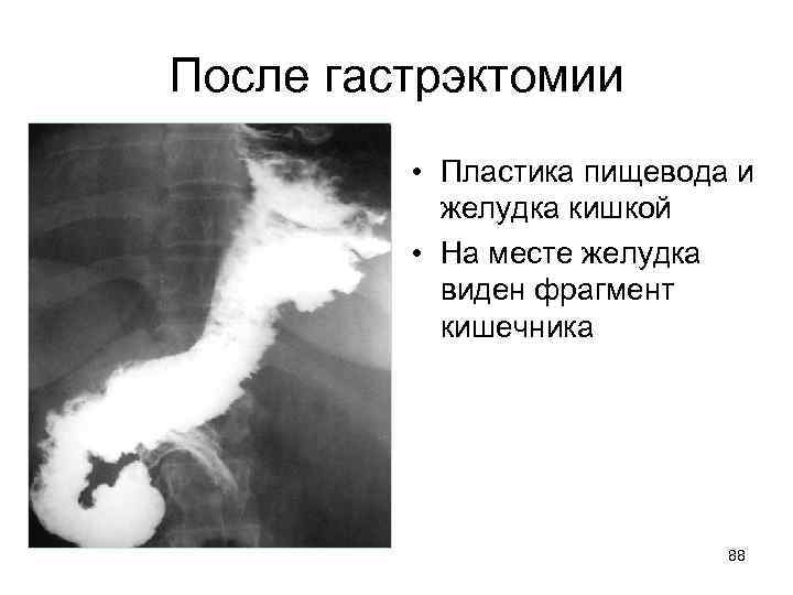 После гастрэктомии • Пластика пищевода и желудка кишкой • На месте желудка виден фрагмент