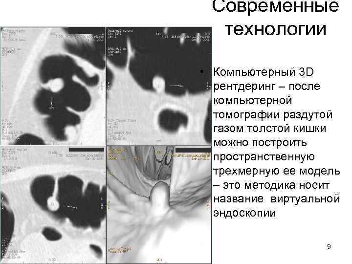 Современные технологии • Компьютерный 3 D рентдеринг – после компьютерной томографии раздутой газом толстой