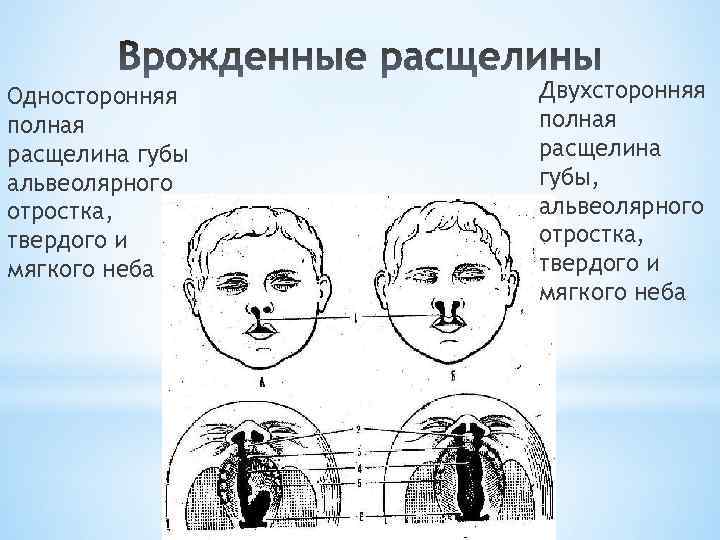 Односторонняя полная расщелина губы альвеолярного отростка, твердого и мягкого неба Двухсторонняя полная расщелина губы,