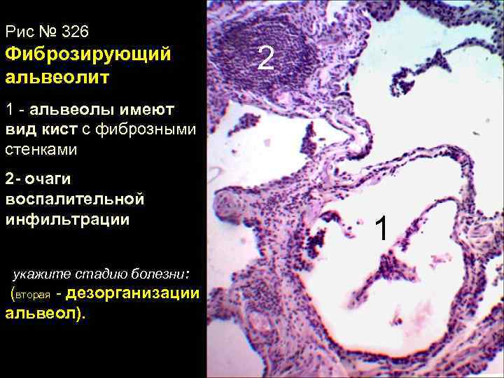 Макроскопическая картина легкого при фиброзирующих альвеолитах