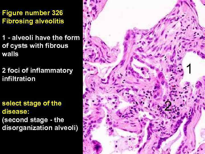 Figure number 326 Fibrosing alveolitis 1 - alveoli have the form of cysts with