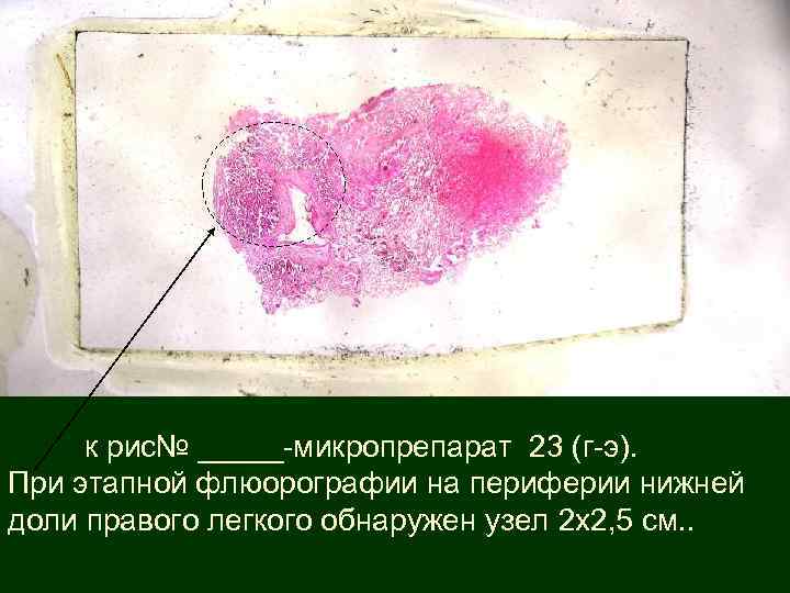  к рис№ _____-микропрепарат 23 (г-э). При этапной флюорографии на периферии нижней доли правого