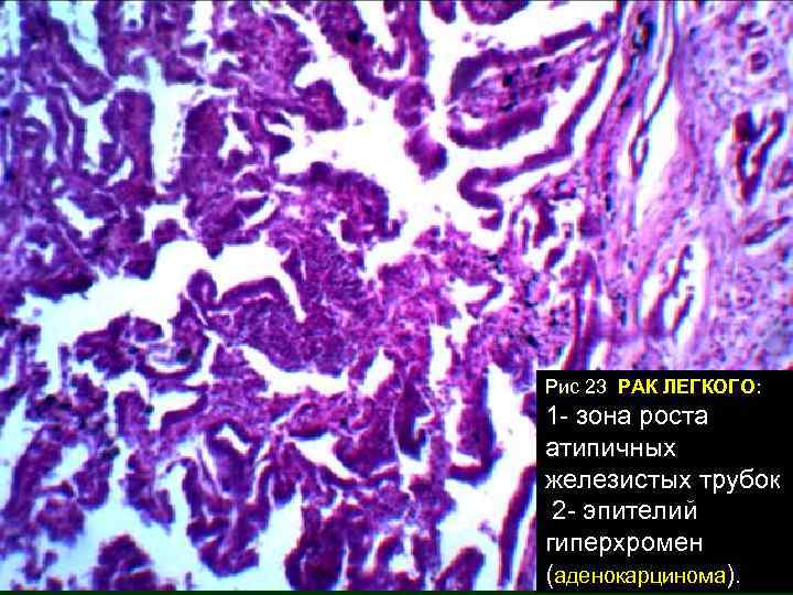 Рис 23 РАК ЛЕГКОГО: 1 - зона роста атипичных железистых трубок 2 - эпителий