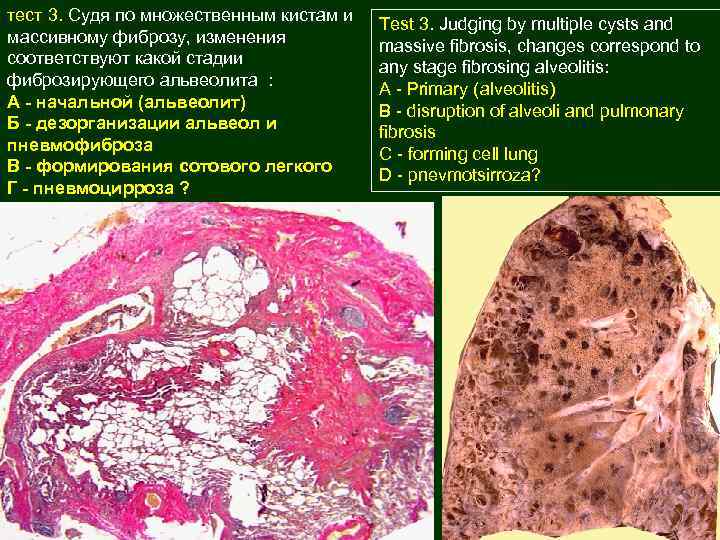 тест 3. Судя по множественным кистам и массивному фиброзу, изменения соответствуют какой стадии фиброзирующего