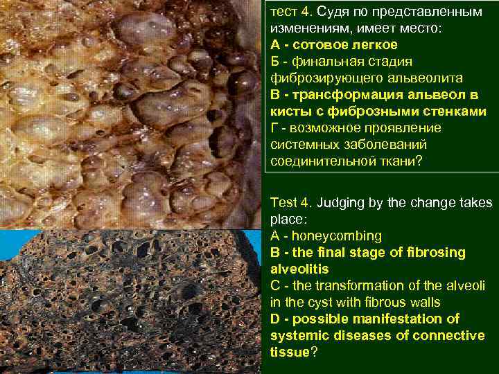 тест 4. Судя по представленным изменениям, имеет место: А - сотовое легкое Б -