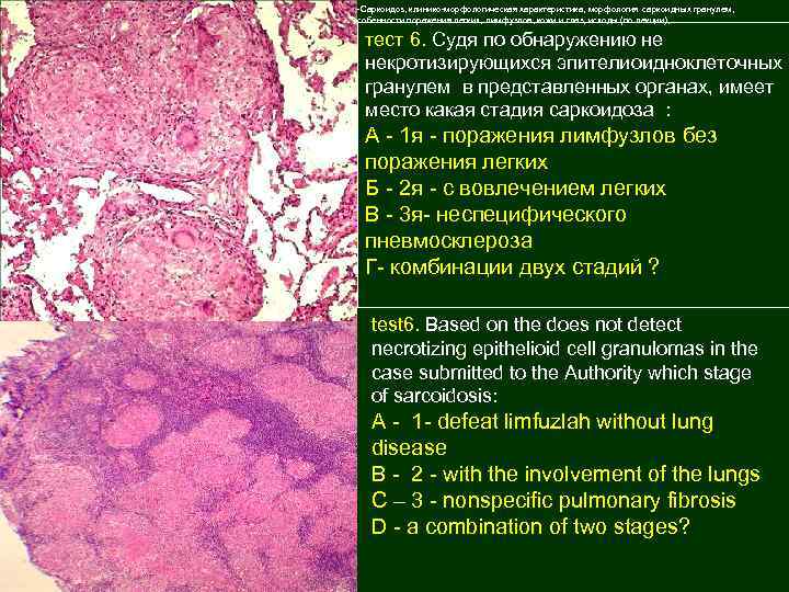 3 -Саркоидоз, клинико-морфологическая характеристика, морфология саркоидных гранулем, особенности поражения легких, лимфузлов, кожи и глаз,