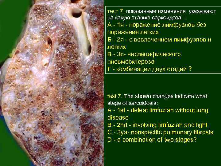 тест 7. показанные изменения указывают на какую стадию саркоидоза : А - 1 я