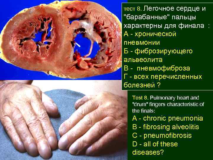 тест 8. Легочное сердце и "барабанные" пальцы характерны для финала : А - хронической