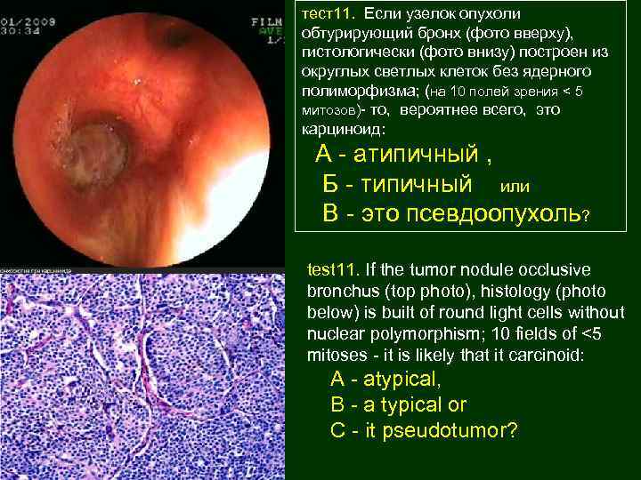 тест11. Если узелок опухоли обтурирующий бронх (фото вверху), гистологически (фото внизу) построен из округлых