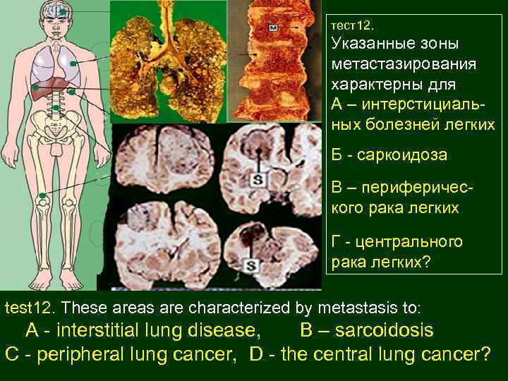 тест12. Указанные зоны метастазирования характерны для: А – интерстициальных болезней легких Б - саркоидоза