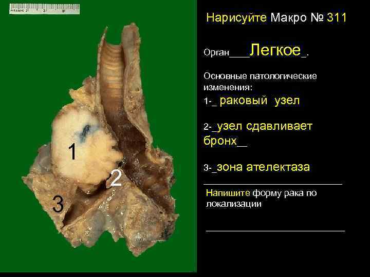  Нарисуйте Макро № 311 Легкое Орган____ _. Основные патологические изменения: 1 -_ раковый