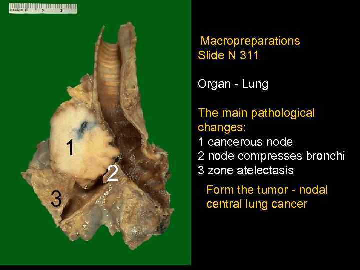  Macropreparations Slide N 311 Organ - Lung 1 2 3 The main pathological