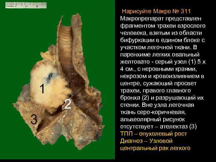  Нарисуйте Макро № 311 1 2 3 Макропрепарат представлен фрагментом трахеи взрослого человека,