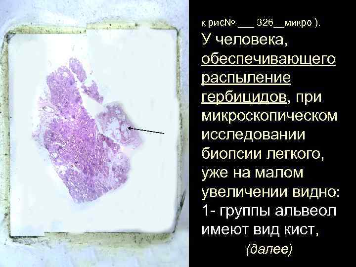к рис№ ___ 326__микро ). У человека, обеспечивающего распыление гербицидов, при микроскопическом исследовании биопсии