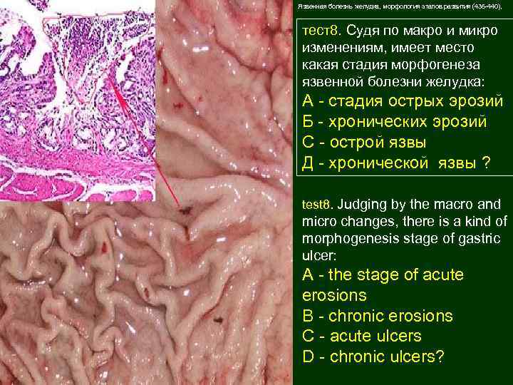 Язвенная болезнь желудка, морфология этапов развития (436 -440), тест8. Cудя по макро и микро