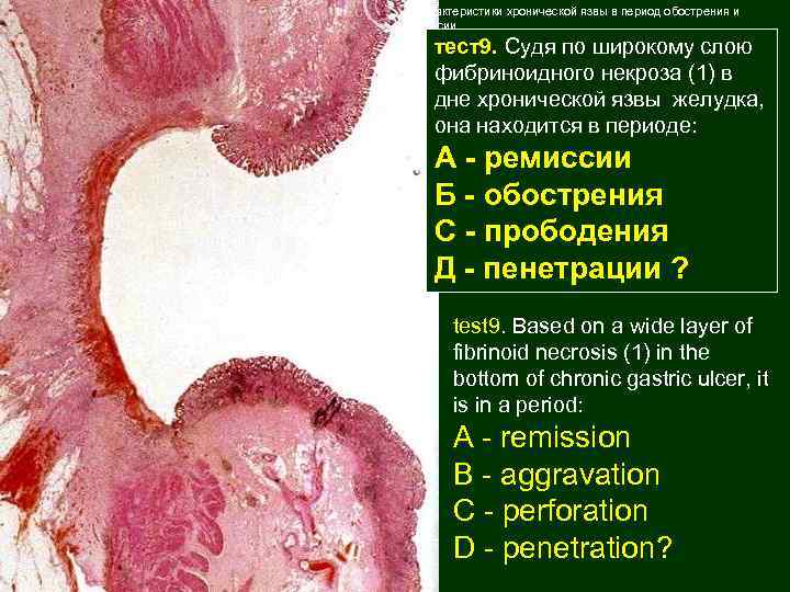 5 -Характеристики хронической язвы в период обострения и ремиссии тест9. Судя по широкому слою