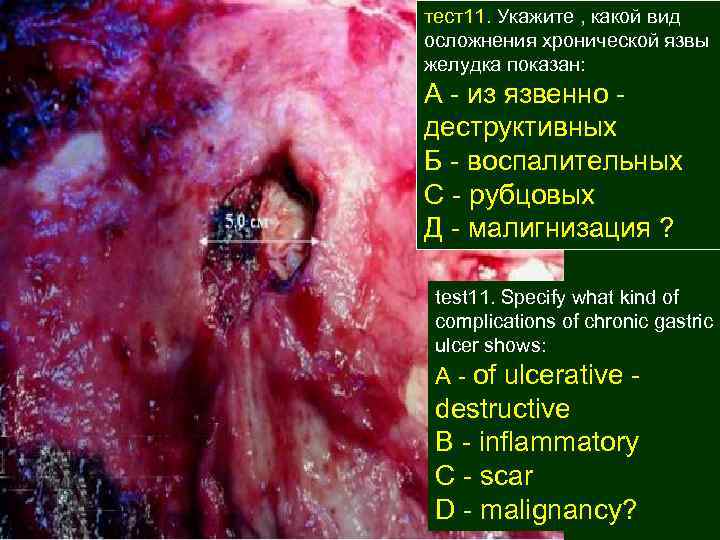 тест11. Укажите , какой вид осложнения хронической язвы желудка показан: А - из язвенно