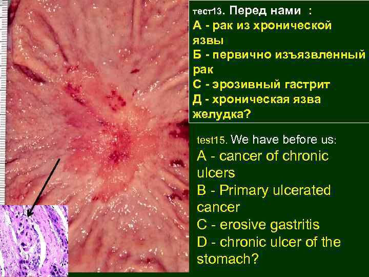 тест13. Перед нами : А - рак из хронической язвы Б - первично изъязвленный