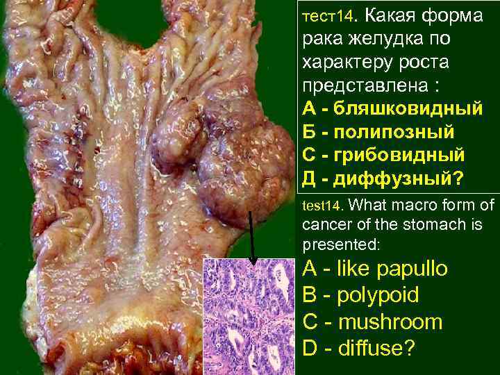 тест14. Какая форма рака желудка по характеру роста представлена : А - бляшковидный Б