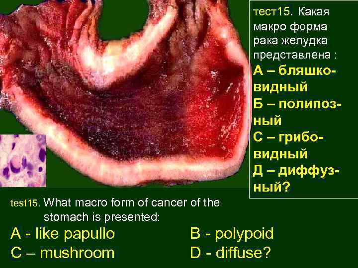 тест15. Какая макро форма рака желудка представлена : А – бляшковидный Б – полипозный