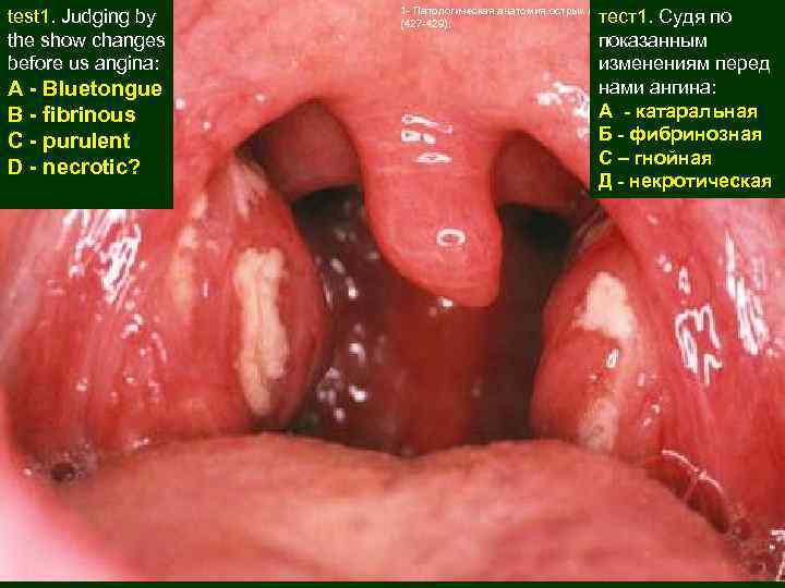 test 1. Judging by the show changes before us angina: A - Bluetongue B