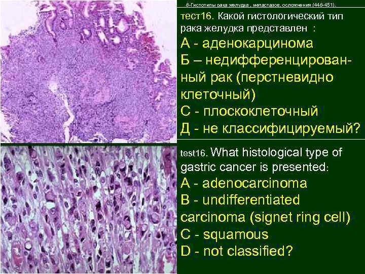 Перстневидно клеточный рак