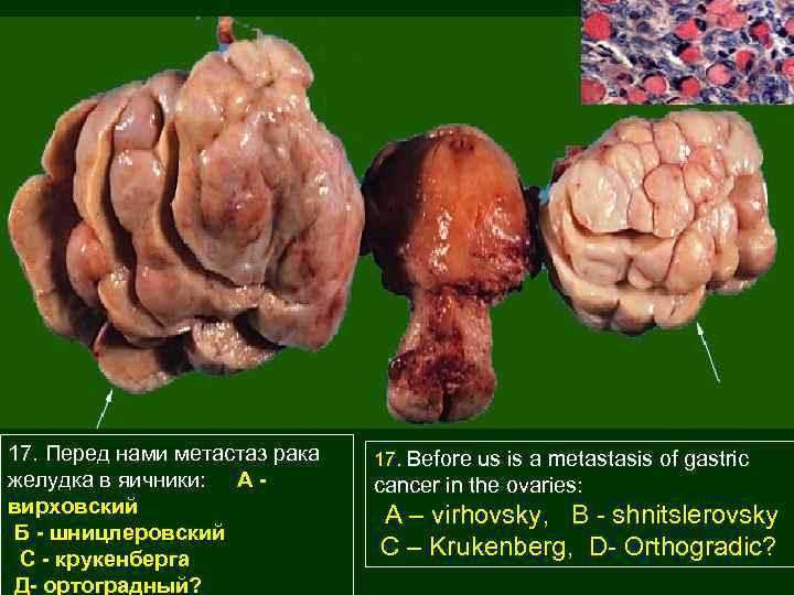 17. Перед нами метастаз рака желудка в яичники: А вирховский Б - шницлеровский С