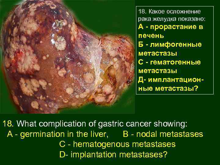 18. Какое осложнение рака желудка показано: А - прорастание в печень Б - лимфогенные