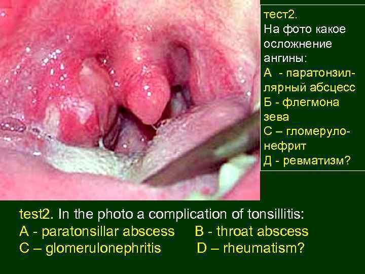 тест2. На фото какое осложнение ангины: А - паратонзиллярный абсцесс Б - флегмона зева