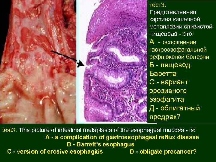 тест3. Представленная картина кишечной метаплазии слизистой пищевода - это: А - осложнение гастроэзофагальной рефлюксной