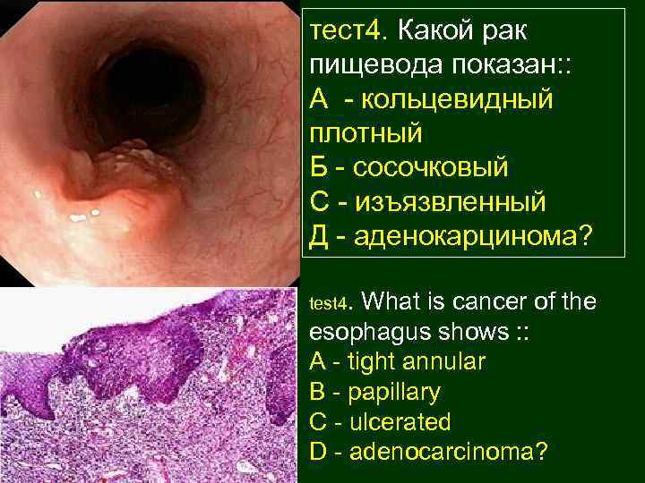 тест4. Какой рак пищевода показан: : А - кольцевидный плотный Б - сосочковый С