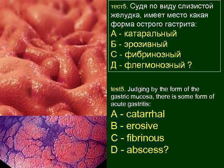 тест5. Судя по виду слизистой желудка, имеет место какая форма острого гастрита: А -