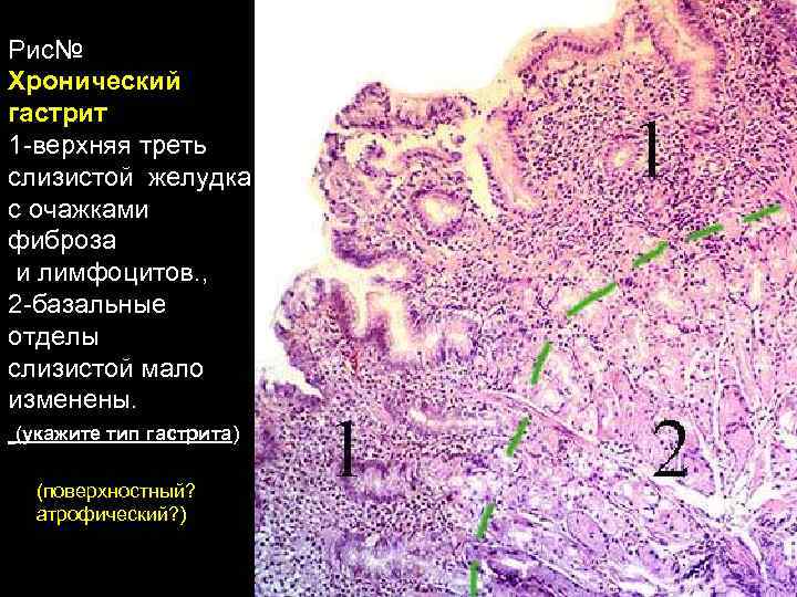 Рис№ Хронический гастрит 1 -верхняя треть слизистой желудка с очажками фиброза и лимфоцитов. ,