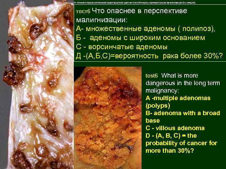 5 - Клинико-морфологическая характеристика аденом толстой кишки, критерии риска малигнизации (по лекции), тест6 Что