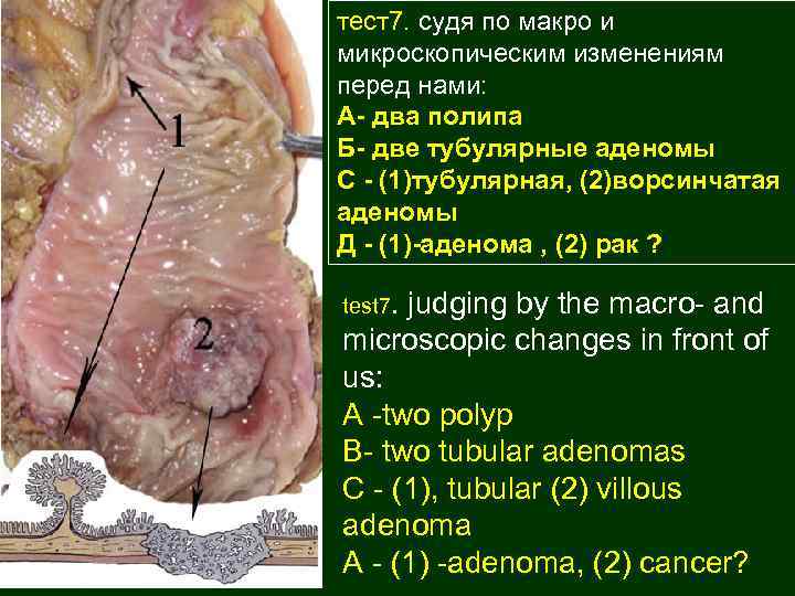 тест7. судя по макро и микроскопическим изменениям перед нами: А- два полипа Б- две