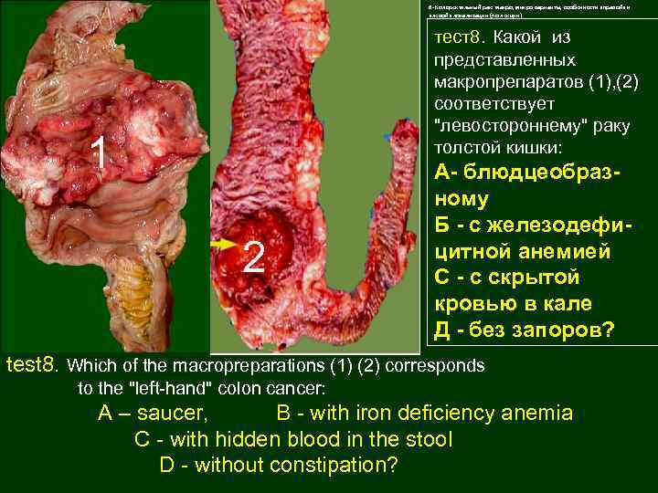 6 - Колоректальный рак: макро, микро варианты, особенности «правой» и «левой» локализации (по лекции)
