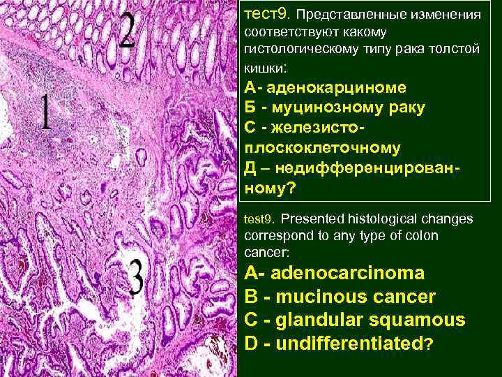 тест9. Представленные изменения соответствуют какому гистологическому типу рака толстой кишки: А- аденокарциноме Б -