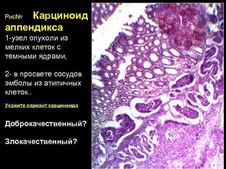 Карциноид. Злокачественный карциноид патанатомия. Карциноид аппендикса гистология. Карциноид червеобразного отростка гистология. Карциноид червеобразного отростка микроскопия.