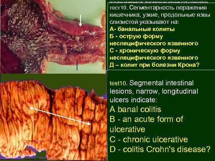 Неспецифический язвенный колит общая характеристика; морфология острой и хронической форм осложнения (459 -461 тест10.