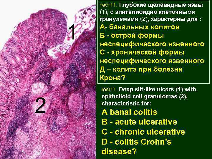 тест11. Глубокие щелевидные язвы 1 (1), с эпителиоидно клеточными гранулемами (2), характерны для :