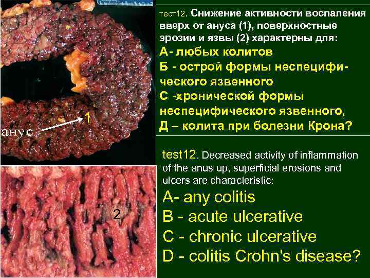 тест12. Снижение активности воспаления вверх от ануса (1), поверхностные эрозии и язвы (2) характерны