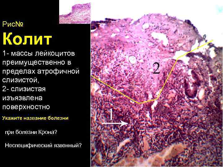 Рис№ Колит 1 - массы лейкоцитов преимущественно в пределах атрофичной слизистой, 2 - слизистая