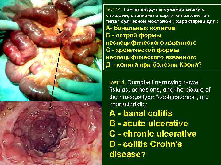 тест14. Гантелевидные сужения кишки с свищами, спайками и картиной слизистой типа "булыжной мостовой", характерны