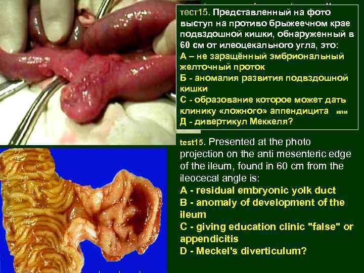 1 -Морфология аномалий кишечника (дивертикул Меккеля, «болезнь» Гиршпрунга. , атрезии, и стенозы)(451 тест15. Представленный