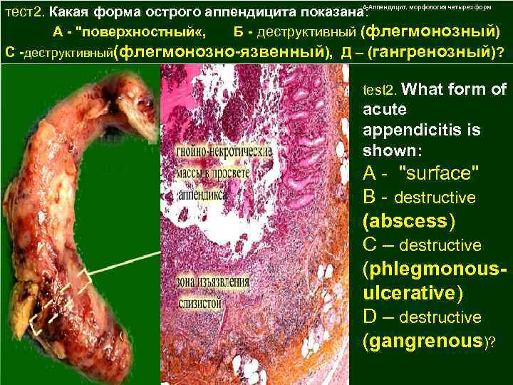 4 -Аппендицит. морфология четырех форм тест2. Какая форма острого аппендицита показана: А - "поверхностный